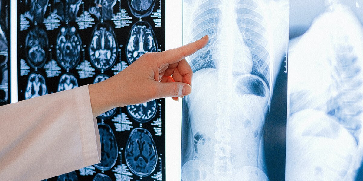 World Osteoporosis Day – looking after your bones