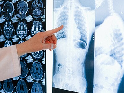 World Osteoporosis Day – looking after your bones